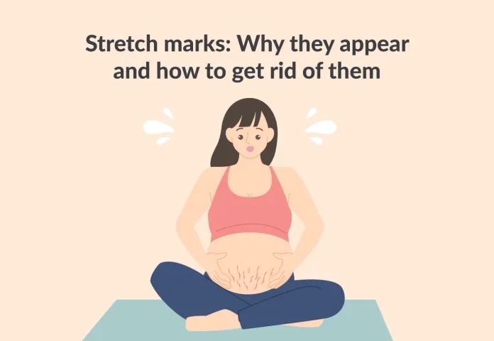 Eliminating pregnancy stretch marks is not difficult with right belly oil!