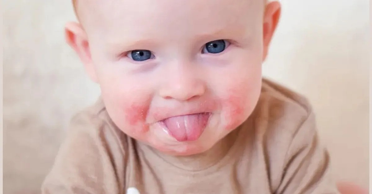 Baby's Drool Rash: The Causes and How to Deal With It