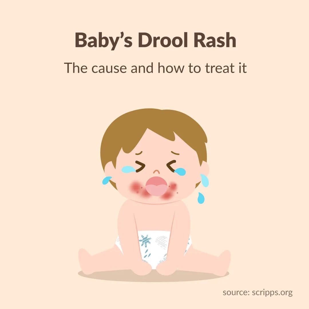 Baby's Drool Rash